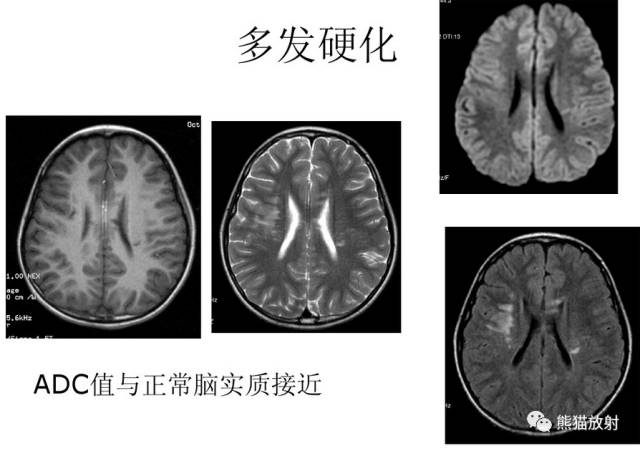 影像PPT - MR入门—手把手教你看DWI和ADC图-32 影像PPT - MR入门—手把手教你看DWI和ADC图-32