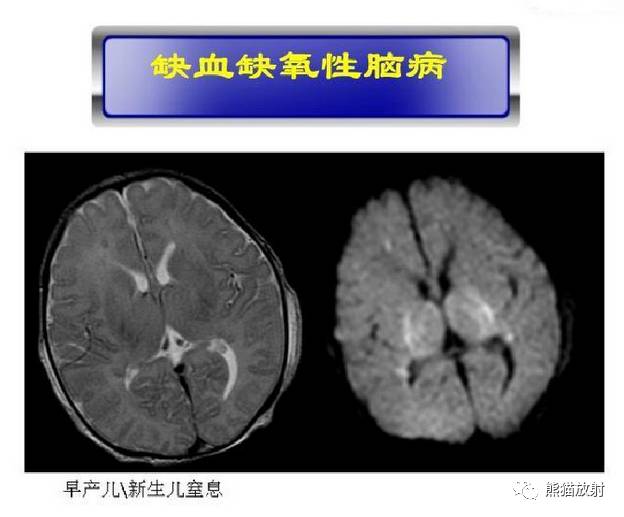 影像PPT - MR入门—手把手教你看DWI和ADC图-41 影像PPT - MR入门—手把手教你看DWI和ADC图-41