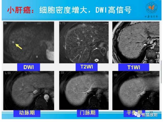 影像PPT - MR入门—手把手教你看DWI和ADC图-42 影像PPT - MR入门—手把手教你看DWI和ADC图-42