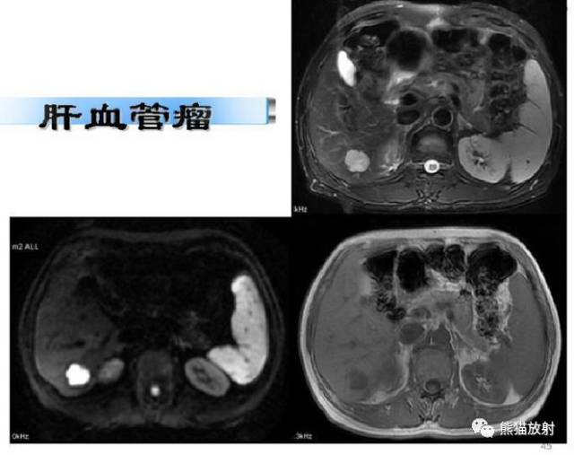 影像PPT - MR入门—手把手教你看DWI和ADC图-44 影像PPT - MR入门—手把手教你看DWI和ADC图-44
