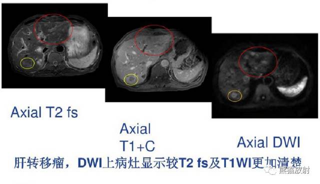 影像PPT - MR入门—手把手教你看DWI和ADC图-45 影像PPT - MR入门—手把手教你看DWI和ADC图-45