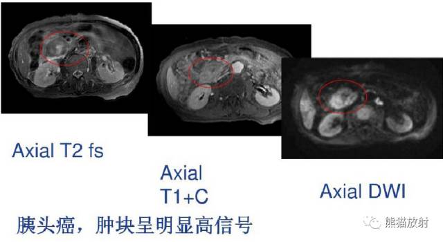 影像PPT - MR入门—手把手教你看DWI和ADC图-47 影像PPT - MR入门—手把手教你看DWI和ADC图-47