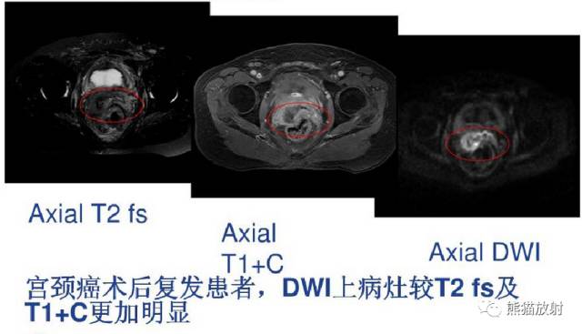 影像PPT - MR入门—手把手教你看DWI和ADC图-48 影像PPT - MR入门—手把手教你看DWI和ADC图-48