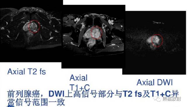 影像PPT - MR入门—手把手教你看DWI和ADC图-49 影像PPT - MR入门—手把手教你看DWI和ADC图-49