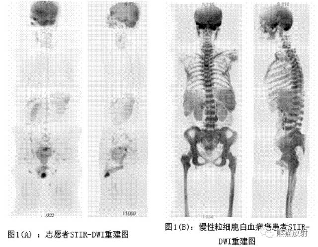 影像PPT - MR入门—手把手教你看DWI和ADC图-53 影像PPT - MR入门—手把手教你看DWI和ADC图-53