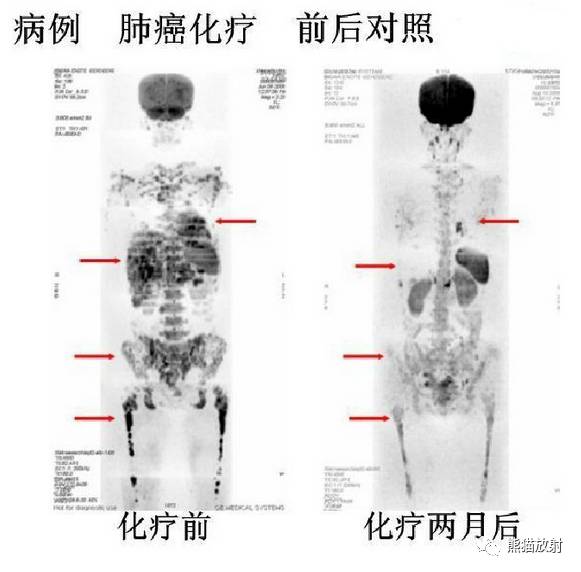 影像PPT - MR入门—手把手教你看DWI和ADC图-56 影像PPT - MR入门—手把手教你看DWI和ADC图-56