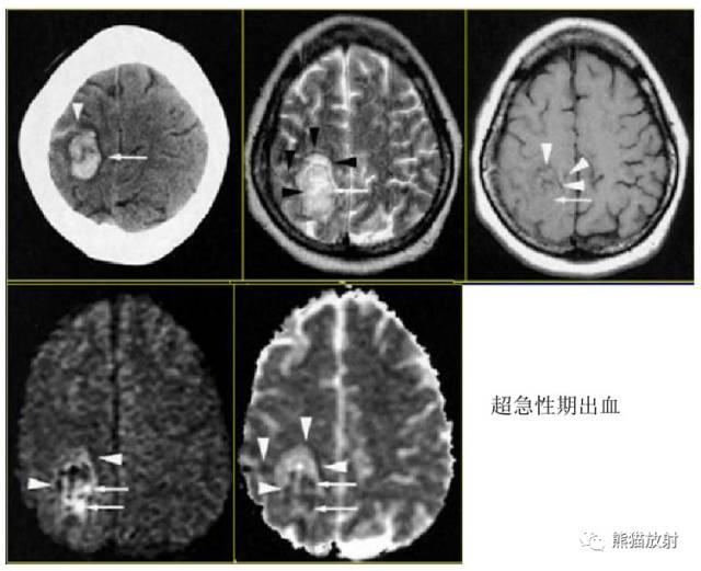 影像PPT - MR入门—手把手教你看DWI和ADC图-3 影像PPT - MR入门—手把手教你看DWI和ADC图-3