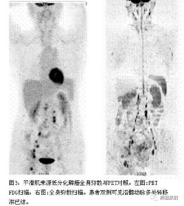 影像PPT - MR入门—手把手教你看DWI和ADC图-4 影像PPT - MR入门—手把手教你看DWI和ADC图-4
