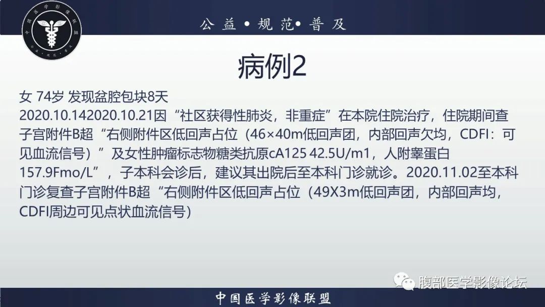 影像PPT - 【病例】卵巢卵泡膜纤维瘤1例CT影像-2