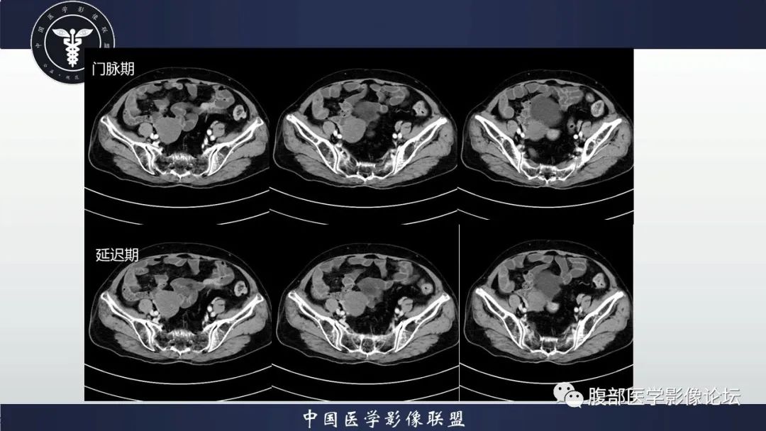 影像PPT - 【病例】卵巢卵泡膜纤维瘤1例CT影像-4