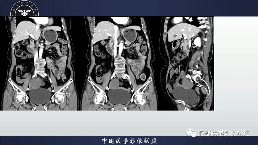 影像PPT - 【病例】卵巢卵泡膜纤维瘤1例CT影像-5