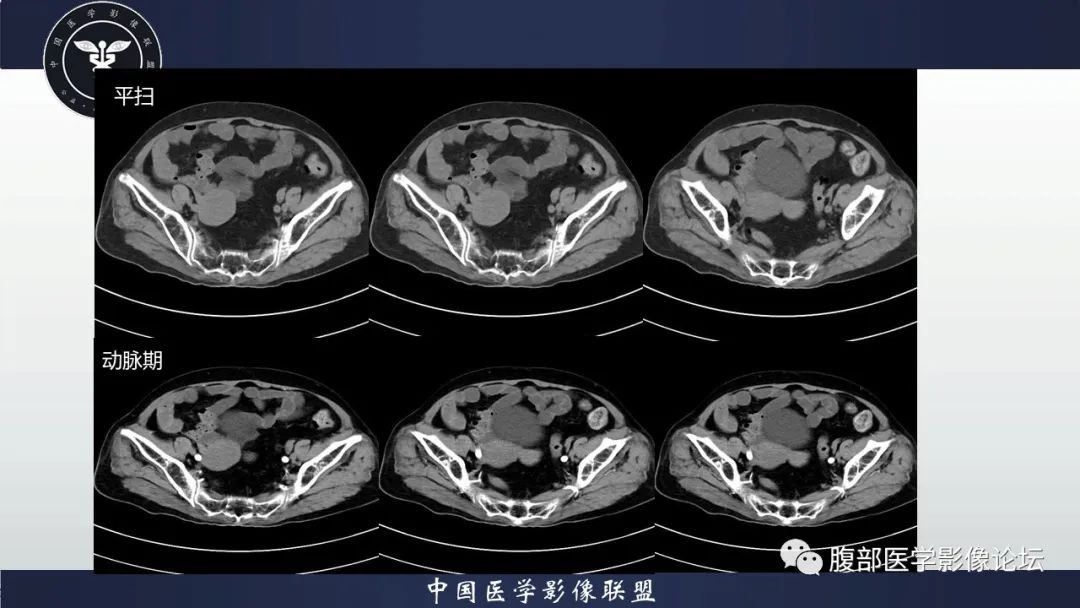 影像PPT - 【病例】卵巢卵泡膜纤维瘤1例CT影像-1