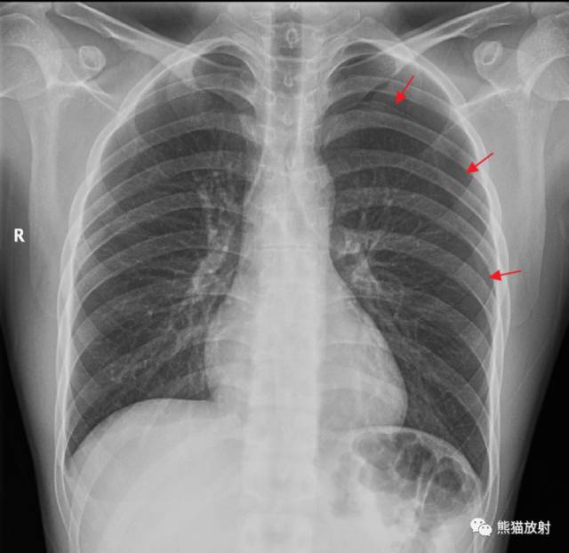 影像PPT - 气胸时如何大体判断肺被压迫的程度?-1 影像PPT - 气胸时如何大体判断肺被压迫的程度?-1