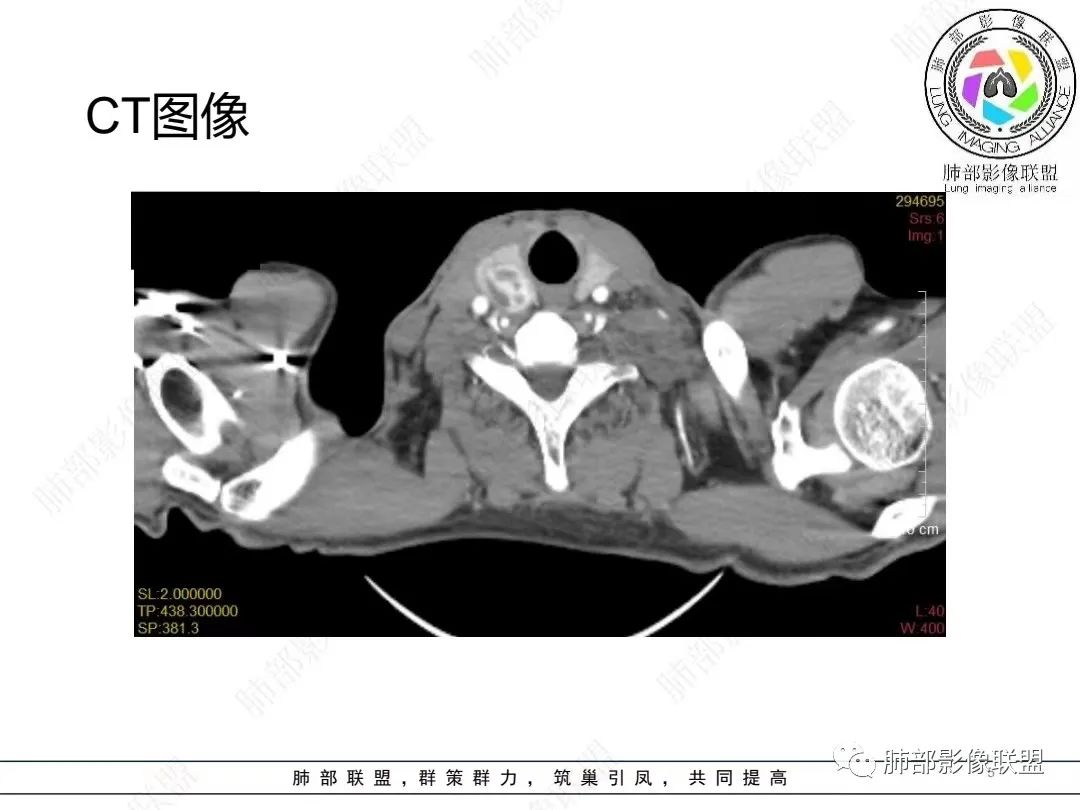 影像PPT - 【病例】胸膜弥漫性连续性增厚—恶性间皮瘤-5 影像PPT - 【病例】胸膜弥漫性连续性增厚—恶性间皮瘤-5