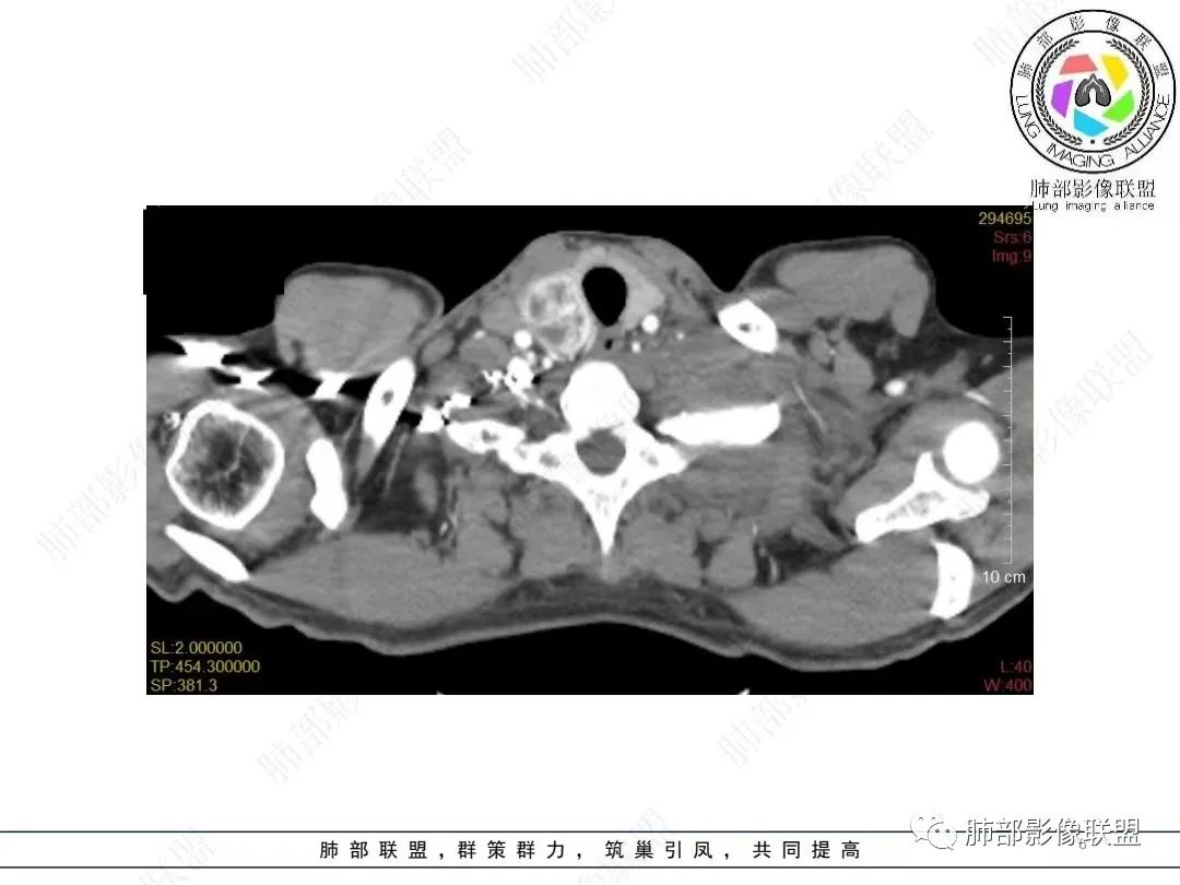 影像PPT - 【病例】胸膜弥漫性连续性增厚—恶性间皮瘤-6 影像PPT - 【病例】胸膜弥漫性连续性增厚—恶性间皮瘤-6