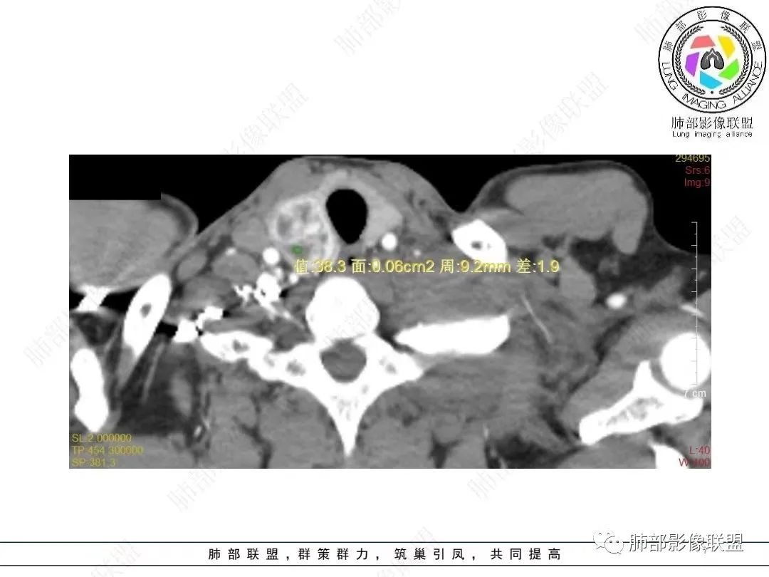 影像PPT - 【病例】胸膜弥漫性连续性增厚—恶性间皮瘤-7 影像PPT - 【病例】胸膜弥漫性连续性增厚—恶性间皮瘤-7
