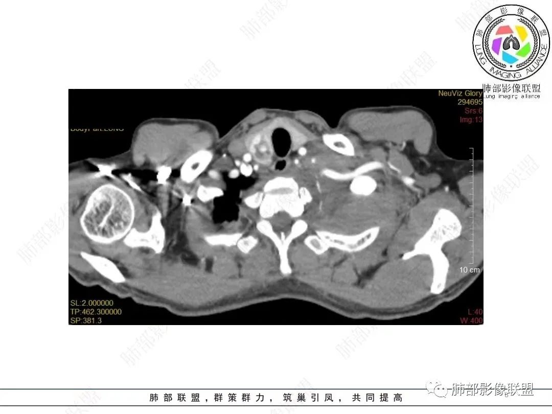 影像PPT - 【病例】胸膜弥漫性连续性增厚—恶性间皮瘤-8 影像PPT - 【病例】胸膜弥漫性连续性增厚—恶性间皮瘤-8