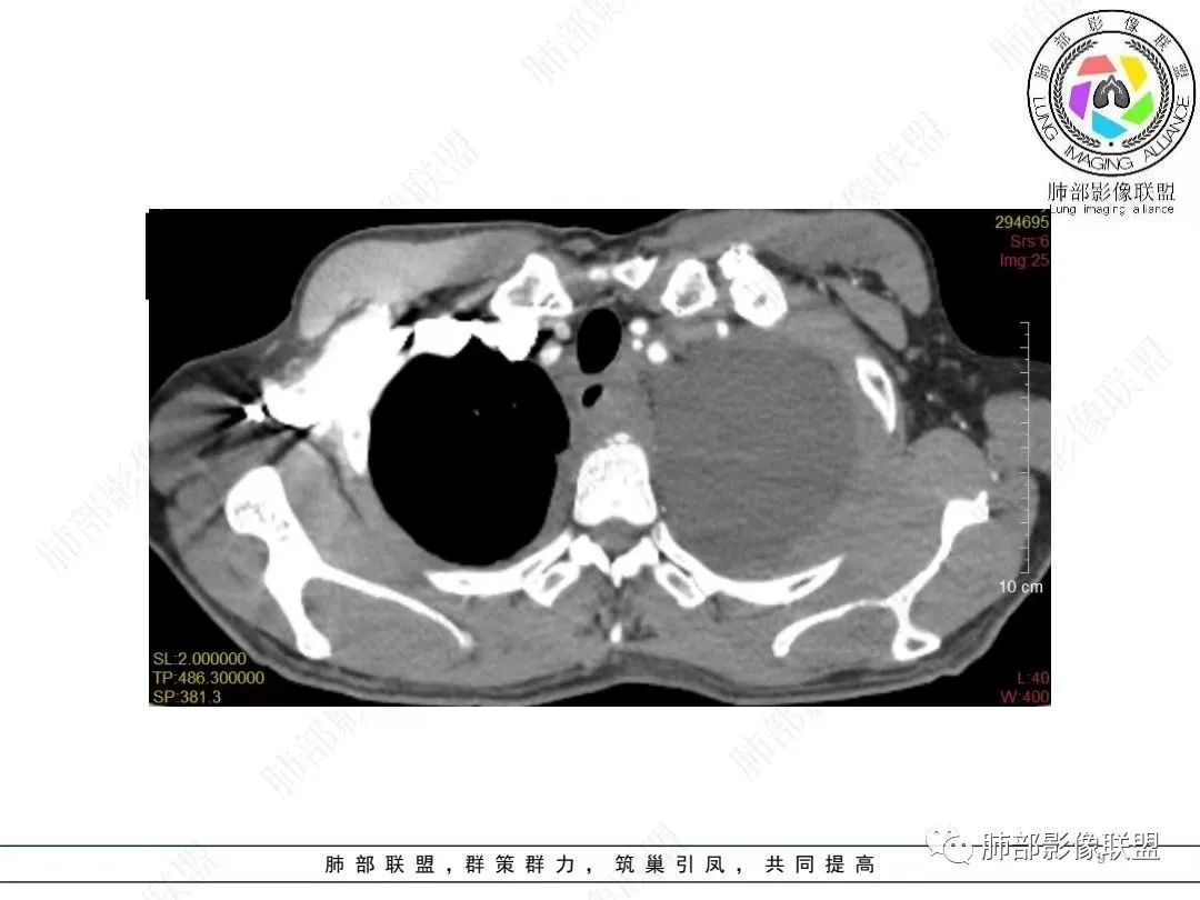 影像PPT - 【病例】胸膜弥漫性连续性增厚—恶性间皮瘤-9 影像PPT - 【病例】胸膜弥漫性连续性增厚—恶性间皮瘤-9