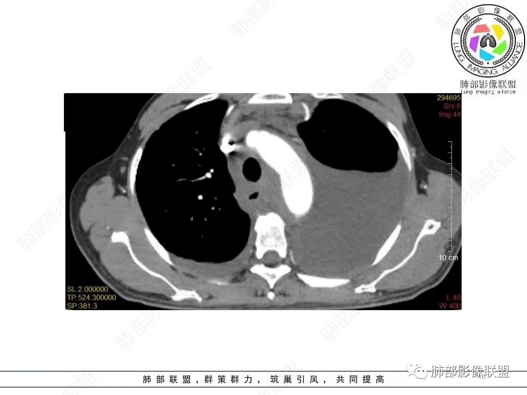 影像PPT - 【病例】胸膜弥漫性连续性增厚—恶性间皮瘤-10 影像PPT - 【病例】胸膜弥漫性连续性增厚—恶性间皮瘤-10