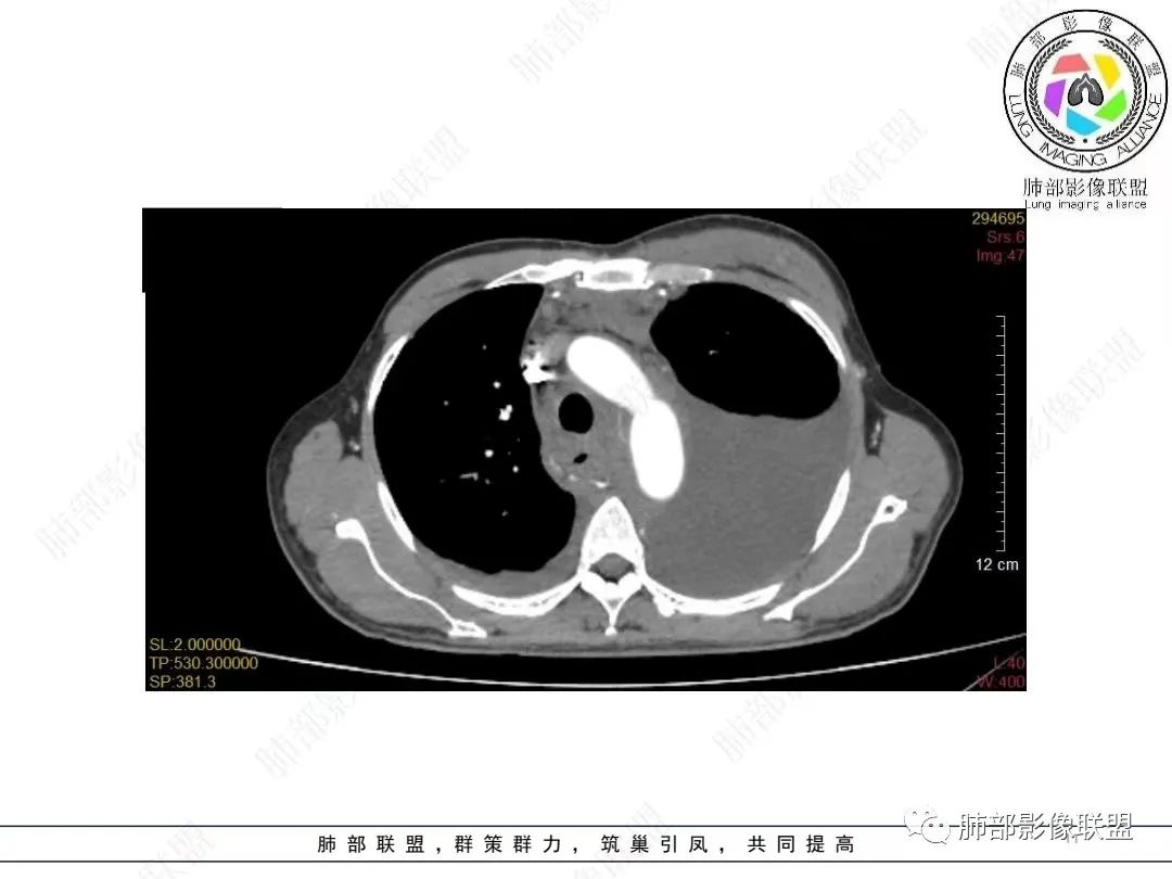 影像PPT - 【病例】胸膜弥漫性连续性增厚—恶性间皮瘤-11 影像PPT - 【病例】胸膜弥漫性连续性增厚—恶性间皮瘤-11