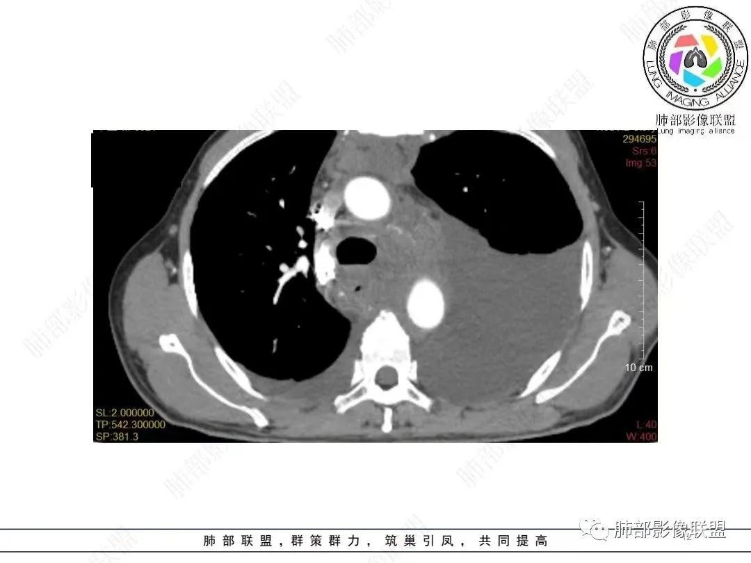影像PPT - 【病例】胸膜弥漫性连续性增厚—恶性间皮瘤-12 影像PPT - 【病例】胸膜弥漫性连续性增厚—恶性间皮瘤-12