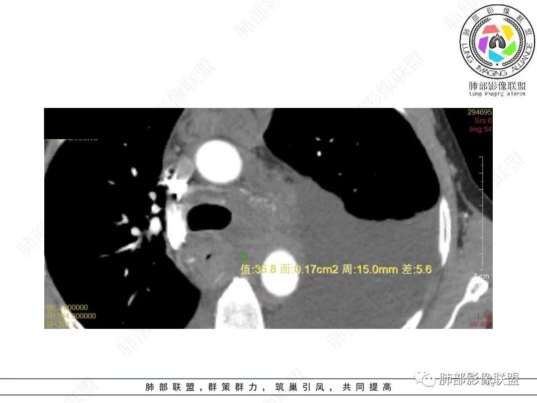 影像PPT - 【病例】胸膜弥漫性连续性增厚—恶性间皮瘤-13 影像PPT - 【病例】胸膜弥漫性连续性增厚—恶性间皮瘤-13