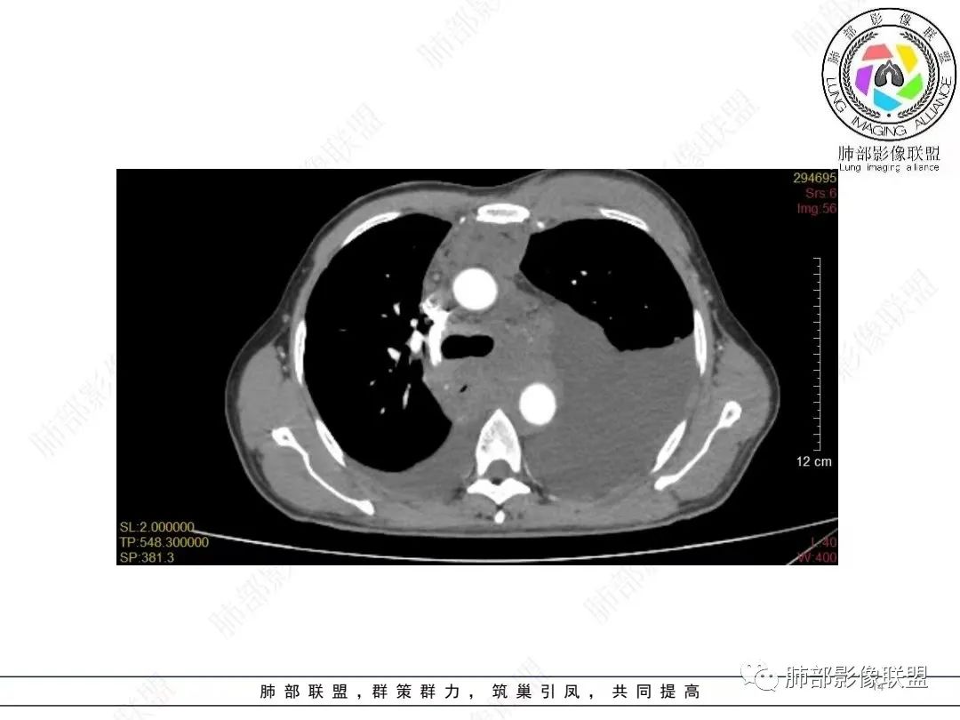 影像PPT - 【病例】胸膜弥漫性连续性增厚—恶性间皮瘤-14 影像PPT - 【病例】胸膜弥漫性连续性增厚—恶性间皮瘤-14