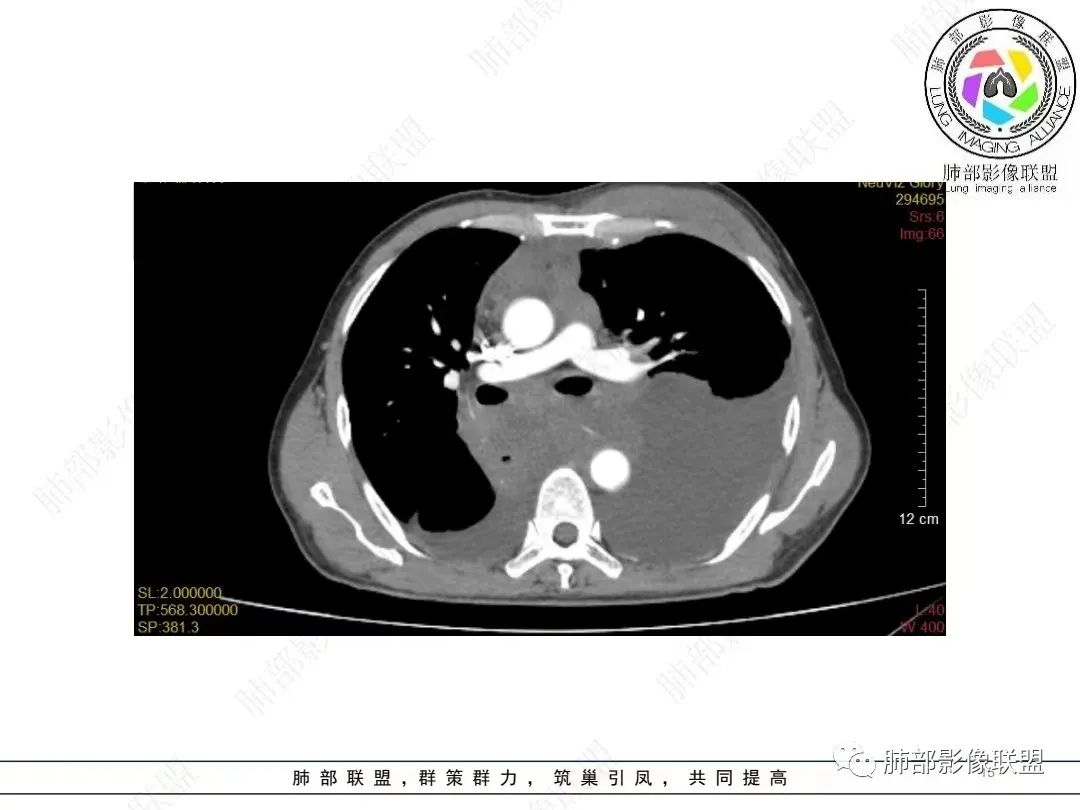 影像PPT - 【病例】胸膜弥漫性连续性增厚—恶性间皮瘤-15 影像PPT - 【病例】胸膜弥漫性连续性增厚—恶性间皮瘤-15