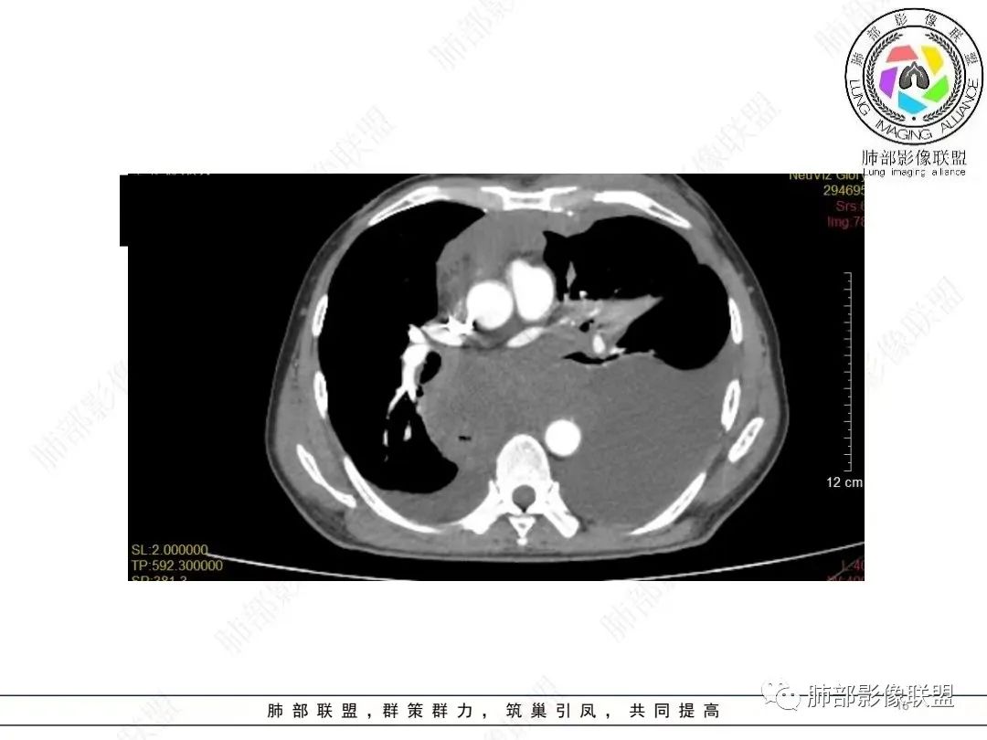 影像PPT - 【病例】胸膜弥漫性连续性增厚—恶性间皮瘤-16 影像PPT - 【病例】胸膜弥漫性连续性增厚—恶性间皮瘤-16