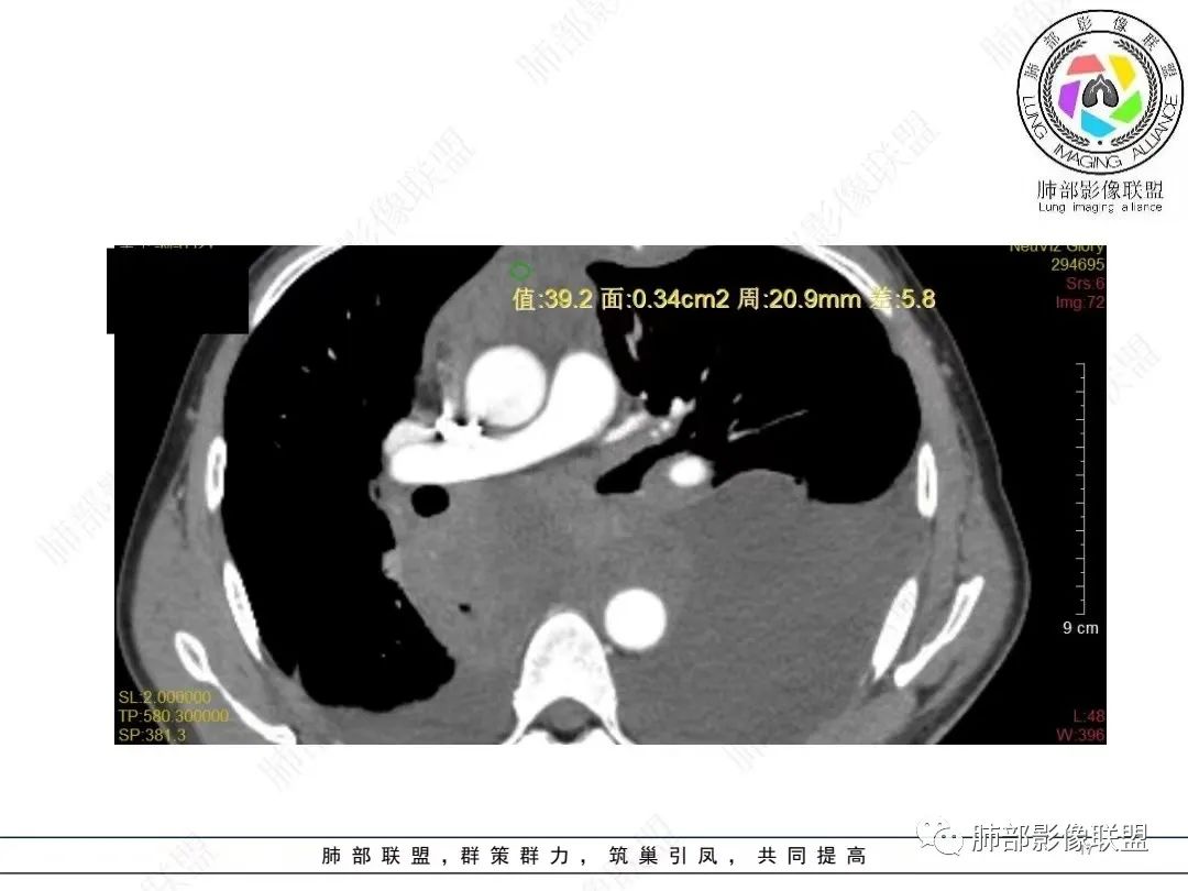 影像PPT - 【病例】胸膜弥漫性连续性增厚—恶性间皮瘤-17 影像PPT - 【病例】胸膜弥漫性连续性增厚—恶性间皮瘤-17