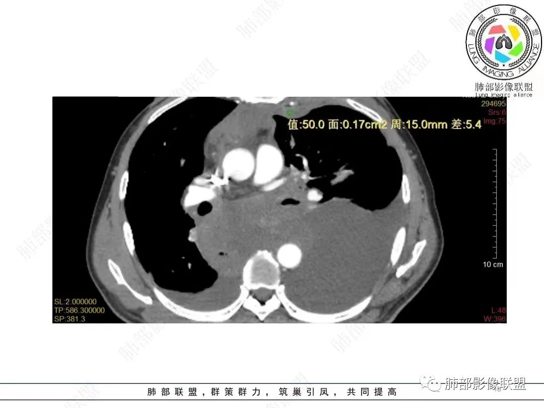 影像PPT - 【病例】胸膜弥漫性连续性增厚—恶性间皮瘤-18 影像PPT - 【病例】胸膜弥漫性连续性增厚—恶性间皮瘤-18