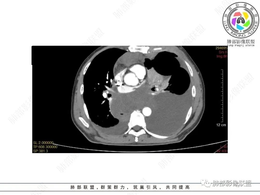 影像PPT - 【病例】胸膜弥漫性连续性增厚—恶性间皮瘤-19 影像PPT - 【病例】胸膜弥漫性连续性增厚—恶性间皮瘤-19