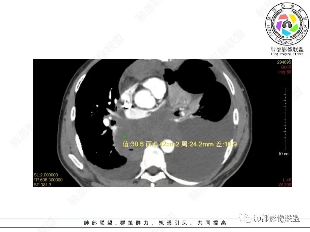 影像PPT - 【病例】胸膜弥漫性连续性增厚—恶性间皮瘤-20 影像PPT - 【病例】胸膜弥漫性连续性增厚—恶性间皮瘤-20