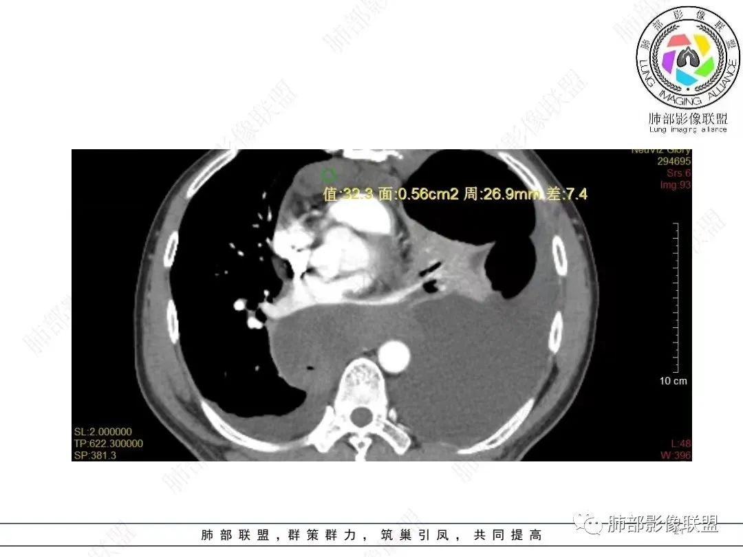 影像PPT - 【病例】胸膜弥漫性连续性增厚—恶性间皮瘤-21 影像PPT - 【病例】胸膜弥漫性连续性增厚—恶性间皮瘤-21