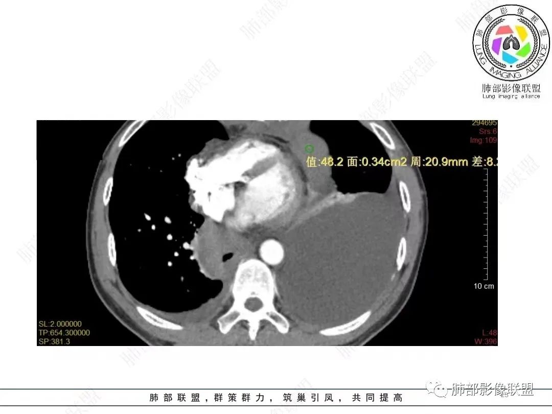 影像PPT - 【病例】胸膜弥漫性连续性增厚—恶性间皮瘤-23 影像PPT - 【病例】胸膜弥漫性连续性增厚—恶性间皮瘤-23