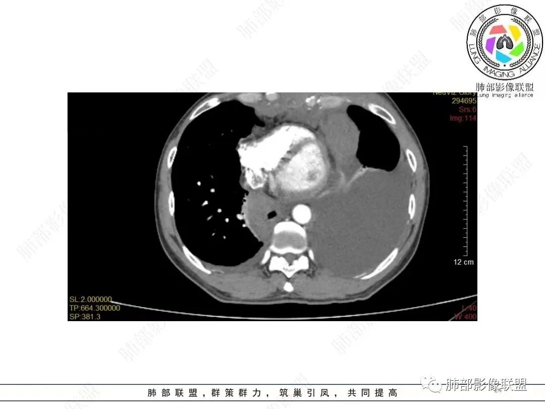 影像PPT - 【病例】胸膜弥漫性连续性增厚—恶性间皮瘤-24 影像PPT - 【病例】胸膜弥漫性连续性增厚—恶性间皮瘤-24