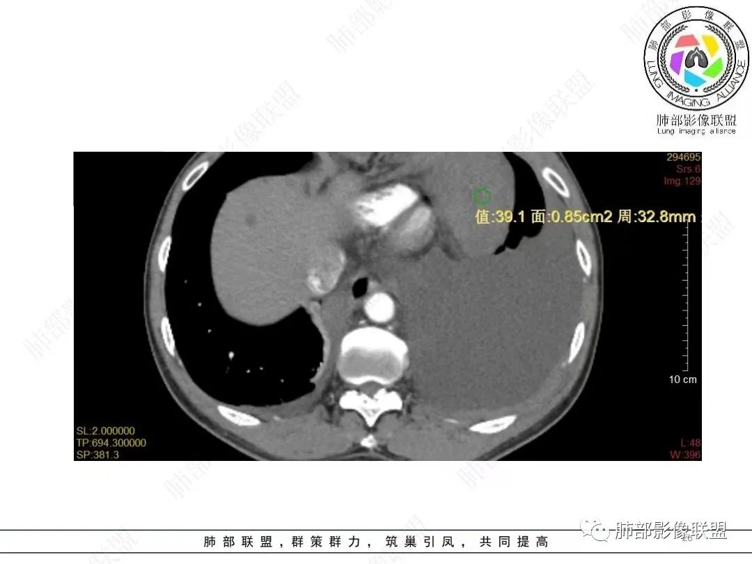 影像PPT - 【病例】胸膜弥漫性连续性增厚—恶性间皮瘤-26 影像PPT - 【病例】胸膜弥漫性连续性增厚—恶性间皮瘤-26