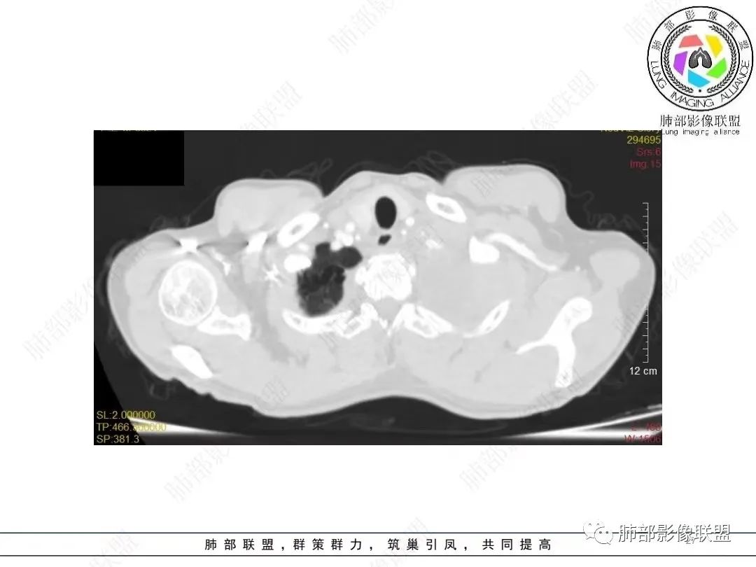 影像PPT - 【病例】胸膜弥漫性连续性增厚—恶性间皮瘤-27 影像PPT - 【病例】胸膜弥漫性连续性增厚—恶性间皮瘤-27