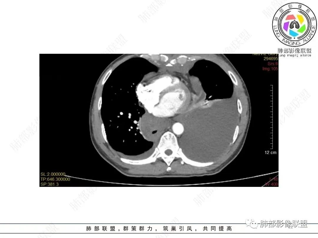 影像PPT - 【病例】胸膜弥漫性连续性增厚—恶性间皮瘤-22 影像PPT - 【病例】胸膜弥漫性连续性增厚—恶性间皮瘤-22