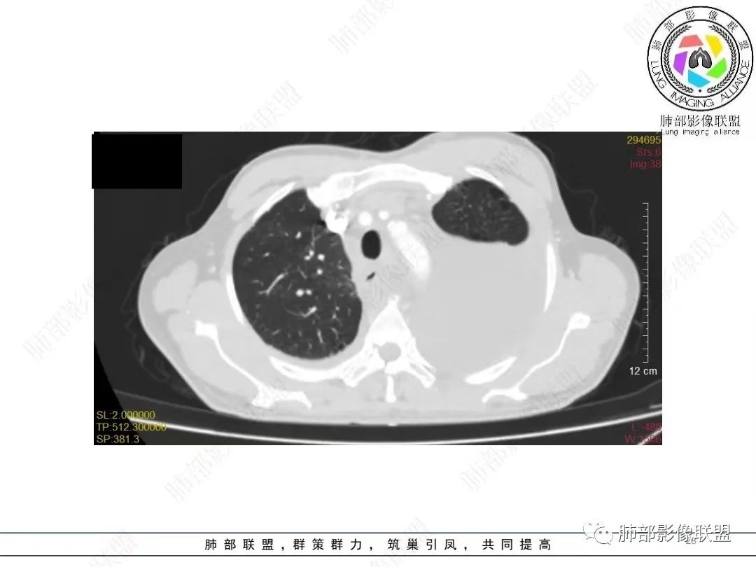 影像PPT - 【病例】胸膜弥漫性连续性增厚—恶性间皮瘤-28 影像PPT - 【病例】胸膜弥漫性连续性增厚—恶性间皮瘤-28