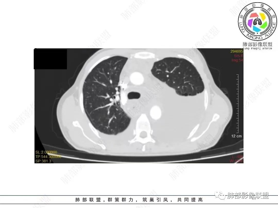 影像PPT - 【病例】胸膜弥漫性连续性增厚—恶性间皮瘤-29 影像PPT - 【病例】胸膜弥漫性连续性增厚—恶性间皮瘤-29