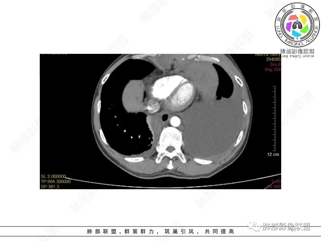 影像PPT - 【病例】胸膜弥漫性连续性增厚—恶性间皮瘤-25 影像PPT - 【病例】胸膜弥漫性连续性增厚—恶性间皮瘤-25
