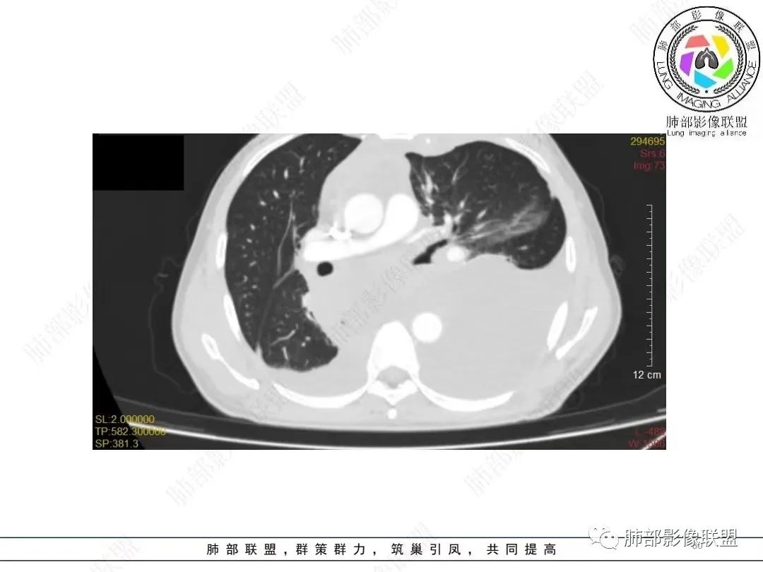 影像PPT - 【病例】胸膜弥漫性连续性增厚—恶性间皮瘤-30 影像PPT - 【病例】胸膜弥漫性连续性增厚—恶性间皮瘤-30