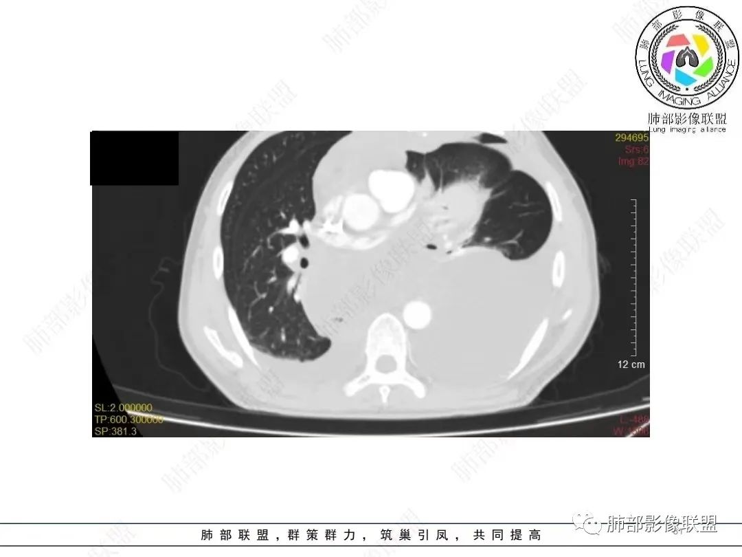 影像PPT - 【病例】胸膜弥漫性连续性增厚—恶性间皮瘤-31 影像PPT - 【病例】胸膜弥漫性连续性增厚—恶性间皮瘤-31