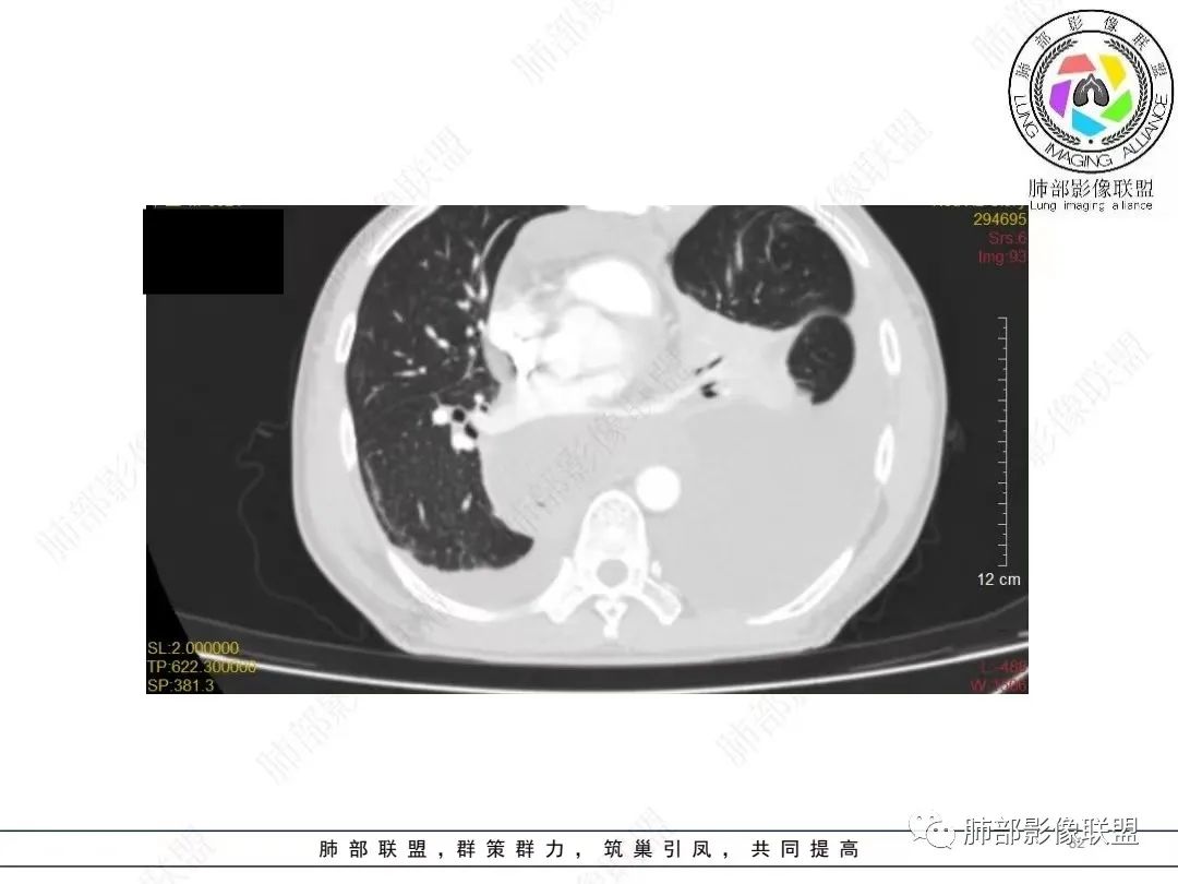 影像PPT - 【病例】胸膜弥漫性连续性增厚—恶性间皮瘤-32 影像PPT - 【病例】胸膜弥漫性连续性增厚—恶性间皮瘤-32