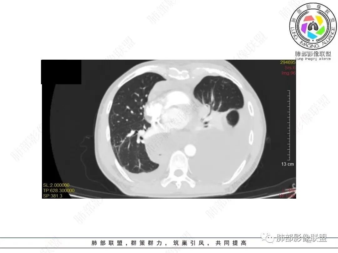 影像PPT - 【病例】胸膜弥漫性连续性增厚—恶性间皮瘤-33 影像PPT - 【病例】胸膜弥漫性连续性增厚—恶性间皮瘤-33