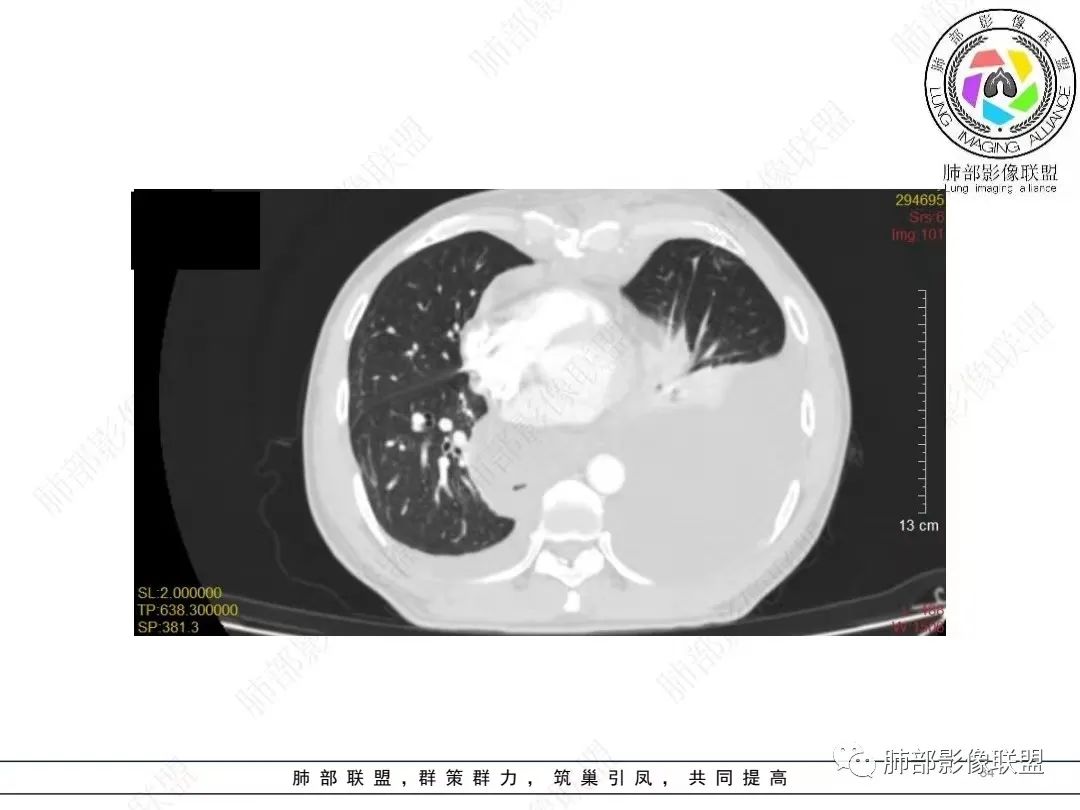影像PPT - 【病例】胸膜弥漫性连续性增厚—恶性间皮瘤-34 影像PPT - 【病例】胸膜弥漫性连续性增厚—恶性间皮瘤-34