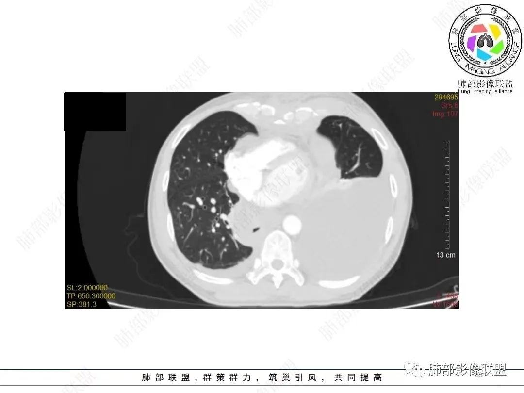 影像PPT - 【病例】胸膜弥漫性连续性增厚—恶性间皮瘤-35 影像PPT - 【病例】胸膜弥漫性连续性增厚—恶性间皮瘤-35