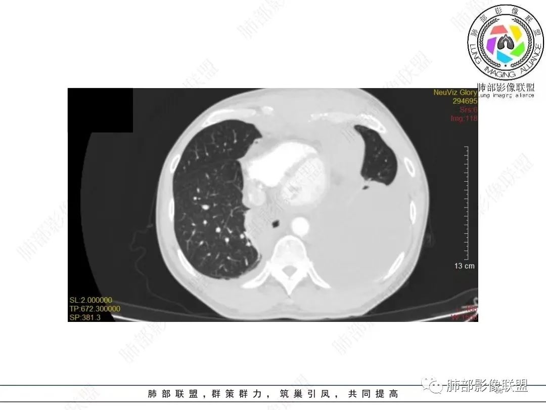 影像PPT - 【病例】胸膜弥漫性连续性增厚—恶性间皮瘤-36 影像PPT - 【病例】胸膜弥漫性连续性增厚—恶性间皮瘤-36