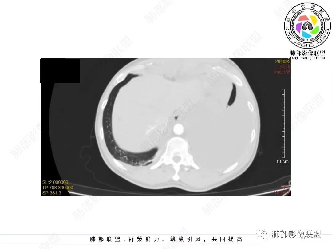 影像PPT - 【病例】胸膜弥漫性连续性增厚—恶性间皮瘤-37 影像PPT - 【病例】胸膜弥漫性连续性增厚—恶性间皮瘤-37